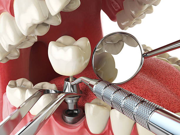 Best Emergency Tooth Extraction in Bryant, AR